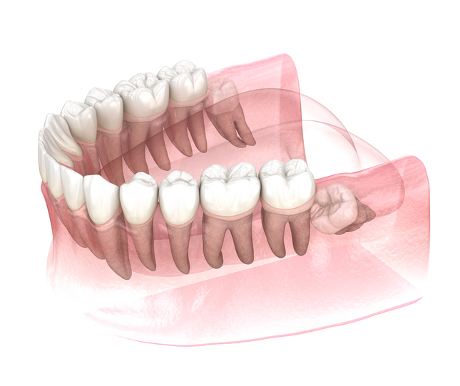 Why Do Wisdom Teeth Need to Be Removed?